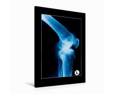 Calvendo Premium Textil-Leinwand 60 cm x 90 cm hoch Seitenansicht eines Kniegelenks | Wandbild, Bild auf Keilrahmen, Fertigbild auf echter Leinwand, Leinwanddruck Menschen Menschen